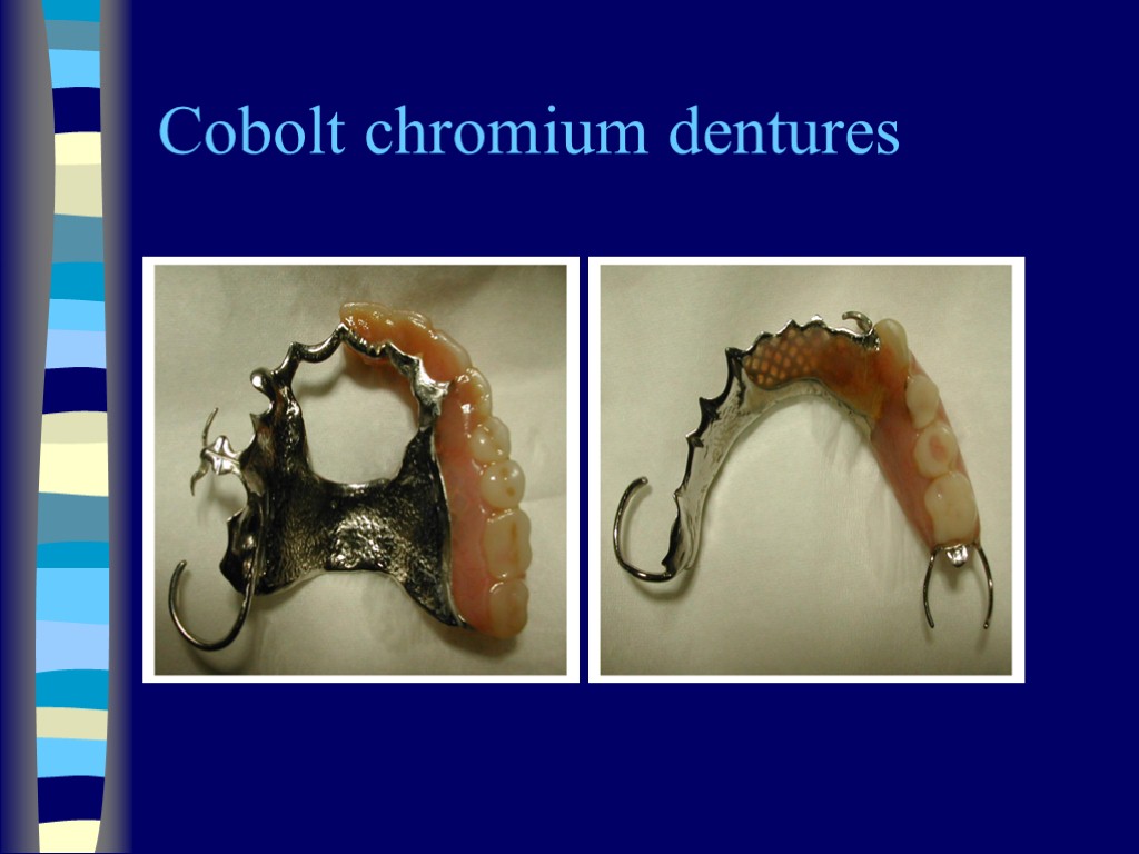 Cobolt chromium dentures